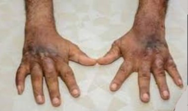 आज मनाया जाएगा एकीकृत निक्षय दिवस, कुष्ठ रोग की भी होगी स्क्रीनिंग